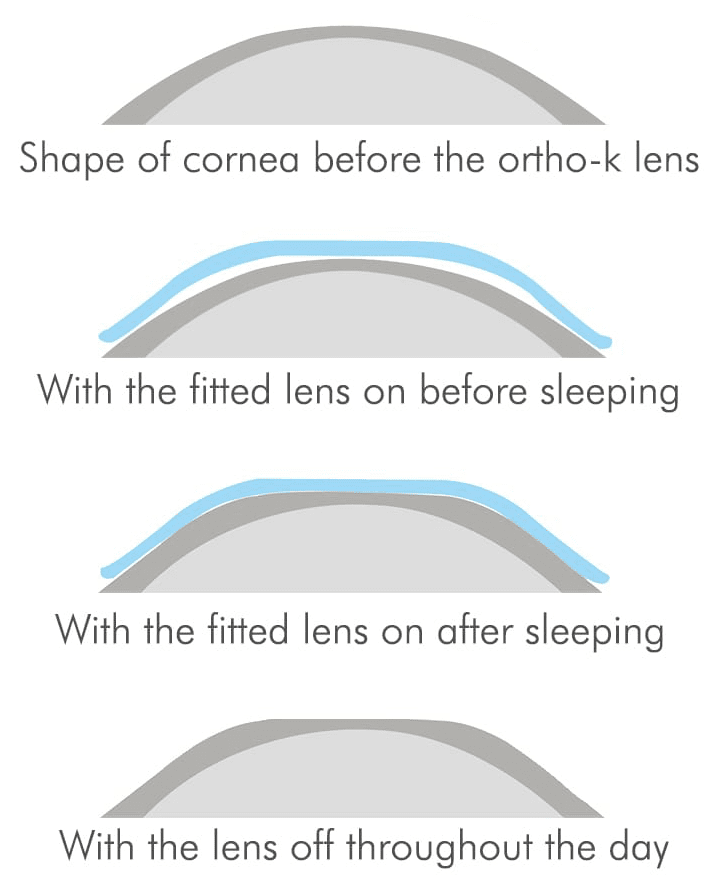 Ortho K Lens Visique Optometrists Hutt Valley Mobile